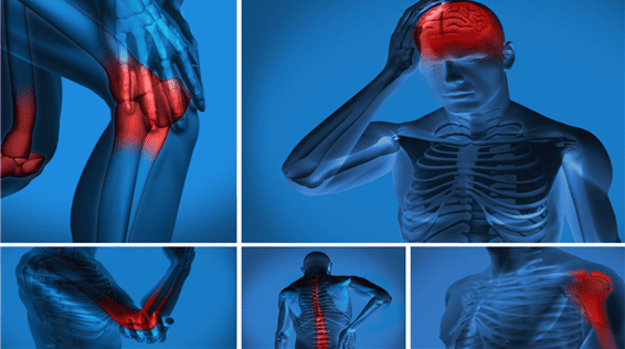 Imagem de raio x de uma pessoa com fibromialgia